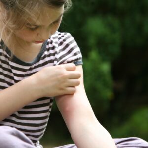 child scratching a mosquito bite